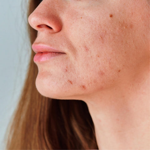 Acne