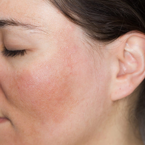 Skin repair